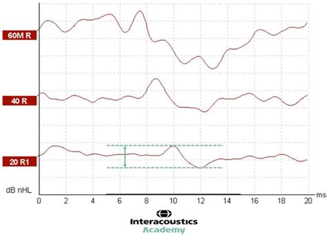 nhl to ehl correction|Comparison of ABR response amplitude, test time, and estimation of.